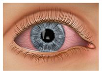 konjuktivitis konjuktivitis